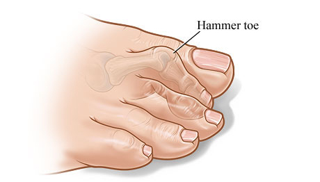 درمان انگشت چکشی-hammer toe